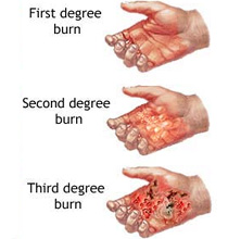 Varying Degree of Burns